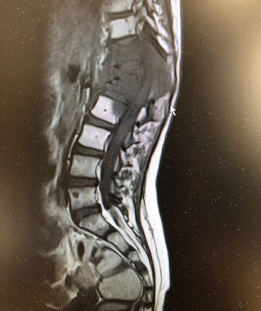 MRI scan of Ruby's spine