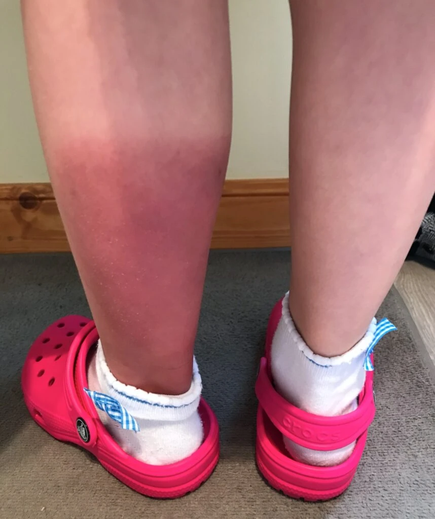 Rubys legs after radiotherapy